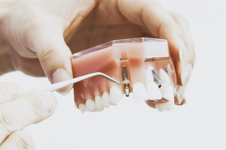 implantes dentales